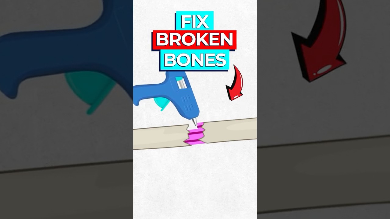 MIT's Bone Glue Gun: 3D Printing Custom Bone Fixes in Minutes