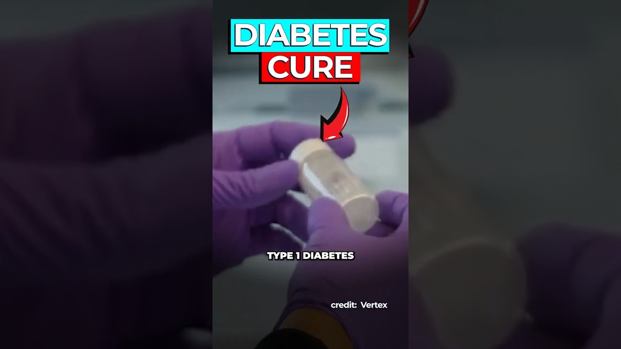 Stem Cell Therapy Cures Type 1 Diabetes in Clinical Trial