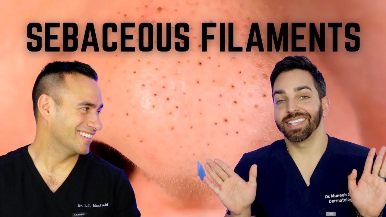 Sebaceous Filaments: Dermatologist Routine for Minimized Pores