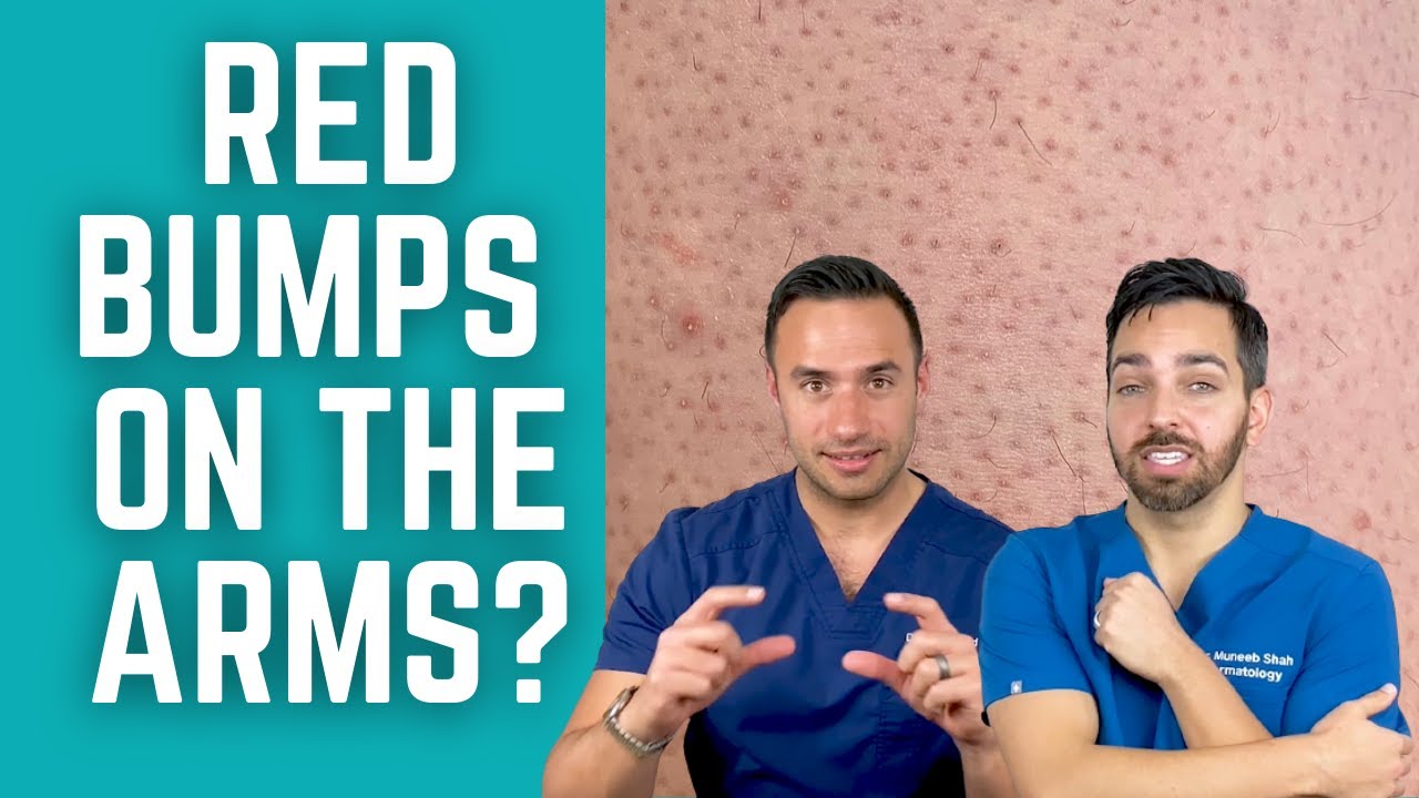 Proven Keratosis Pilaris Treatments: Dermatologist's Guide