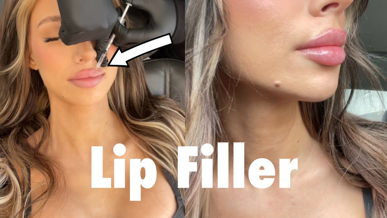 Why Finding the Right Lip Injector Matters: My Experience