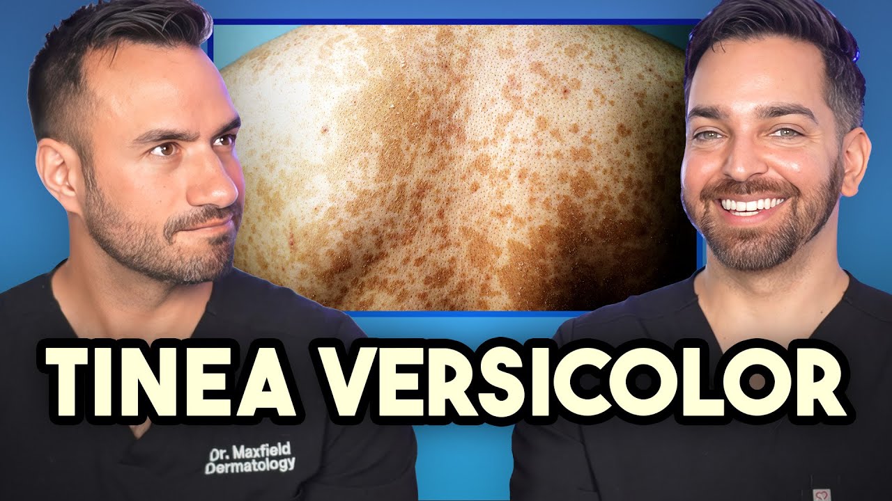 Tinea Versicolor Treatment Guide: Symptoms, Causes & Solutions