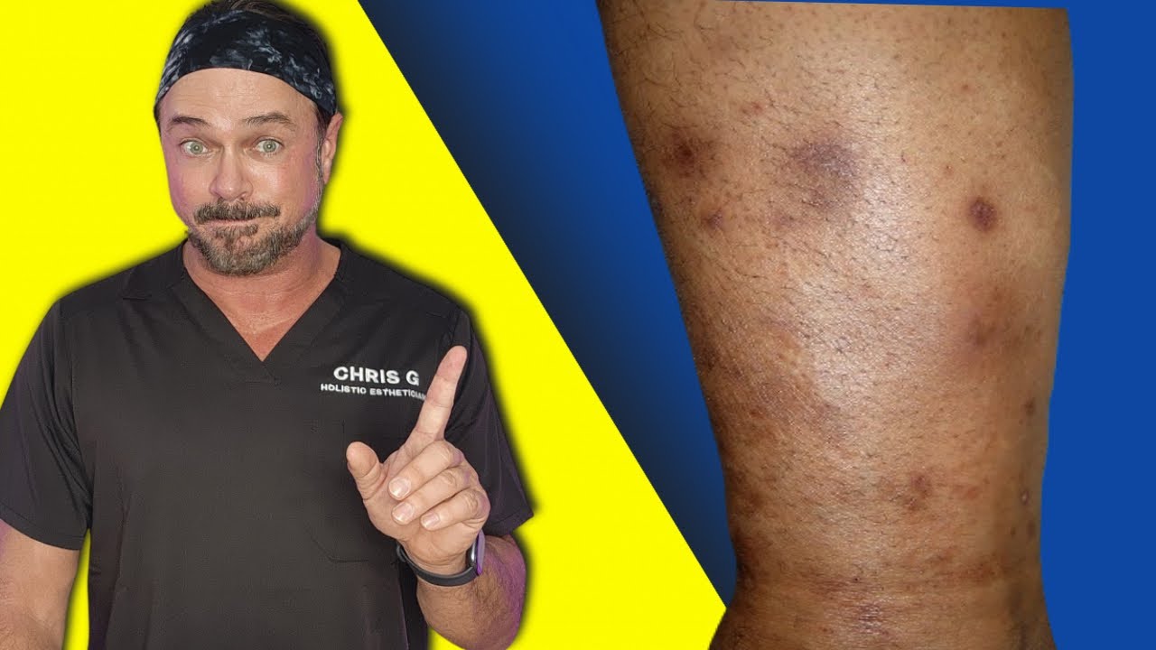 Turmeric Skincare: Natural Solution for Dark Elbows & Knees