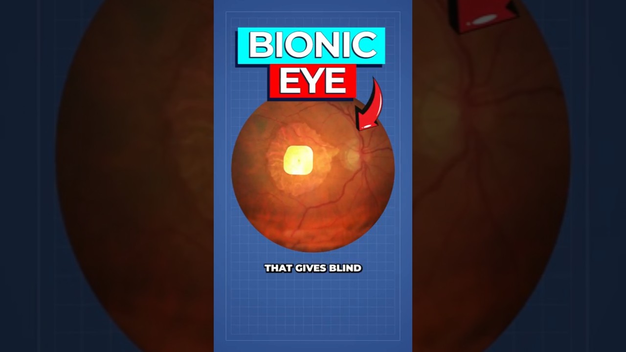 Stanford Retinal Implant Restores Vision for Macular Degeneration