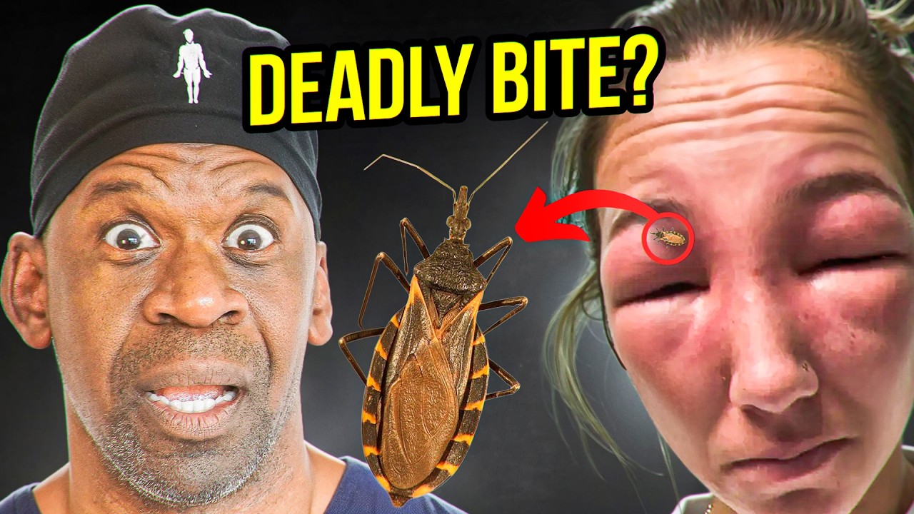 Kissing Bug Risks: Chagas Disease Symptoms & US Prevention