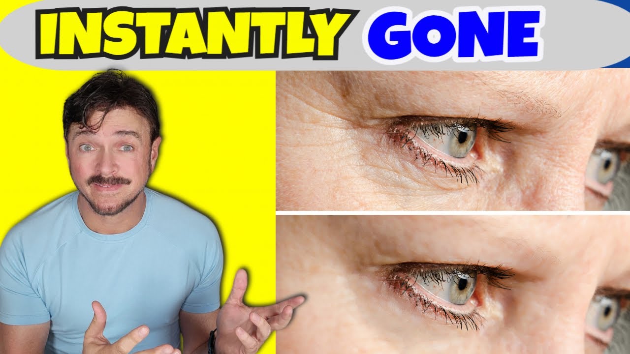 Vanishing Act Blind Filler: Instant Wrinkle Reduction & Long-Term Benefits