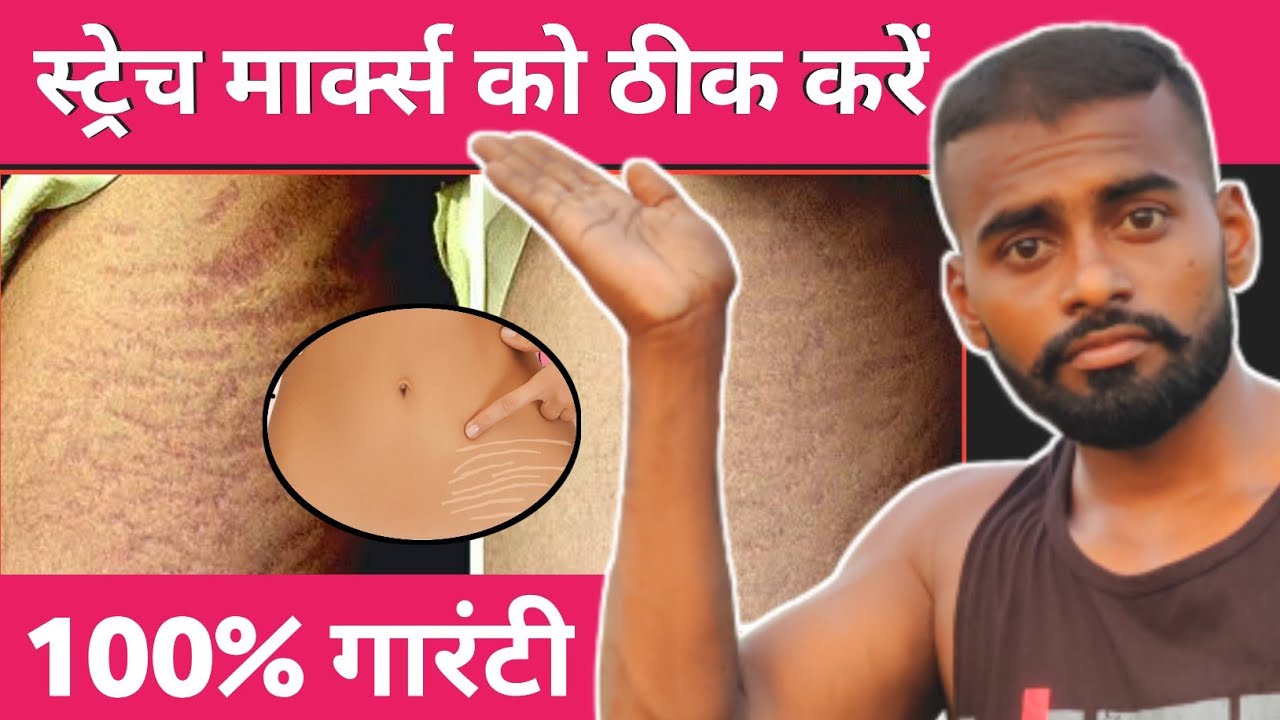Stretch Marks in Bodybuilding: Why They Happen & Why You Shouldn't Worry