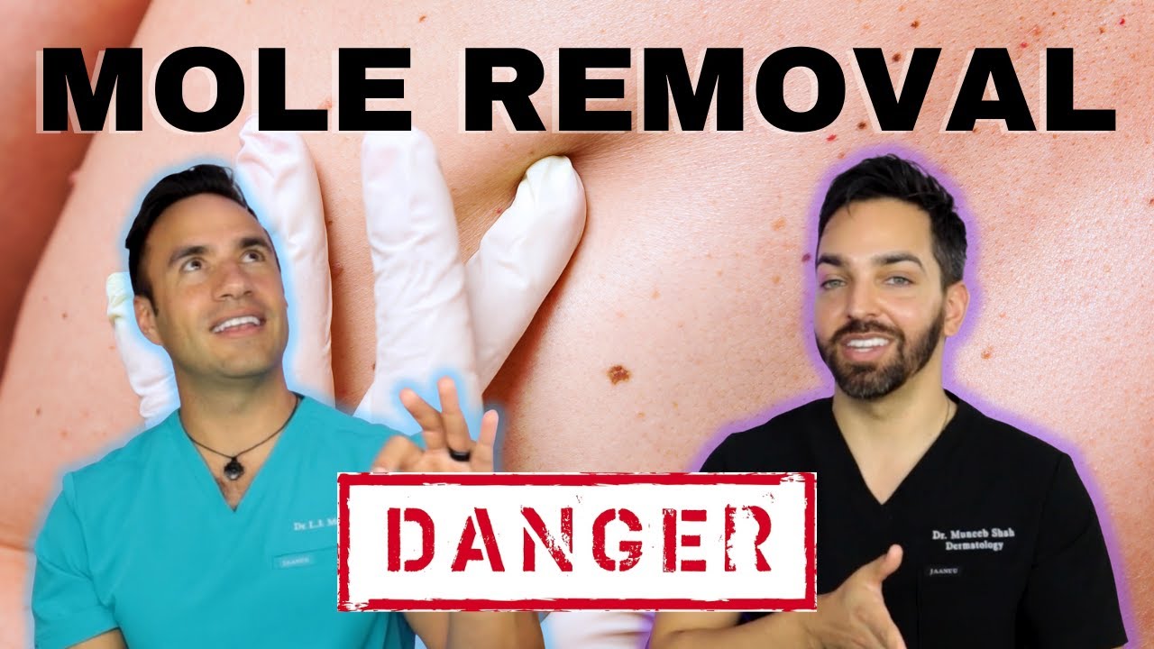Safe Mole Removal: Why DIY is Dangerous & Dermatologist-Approved Methods