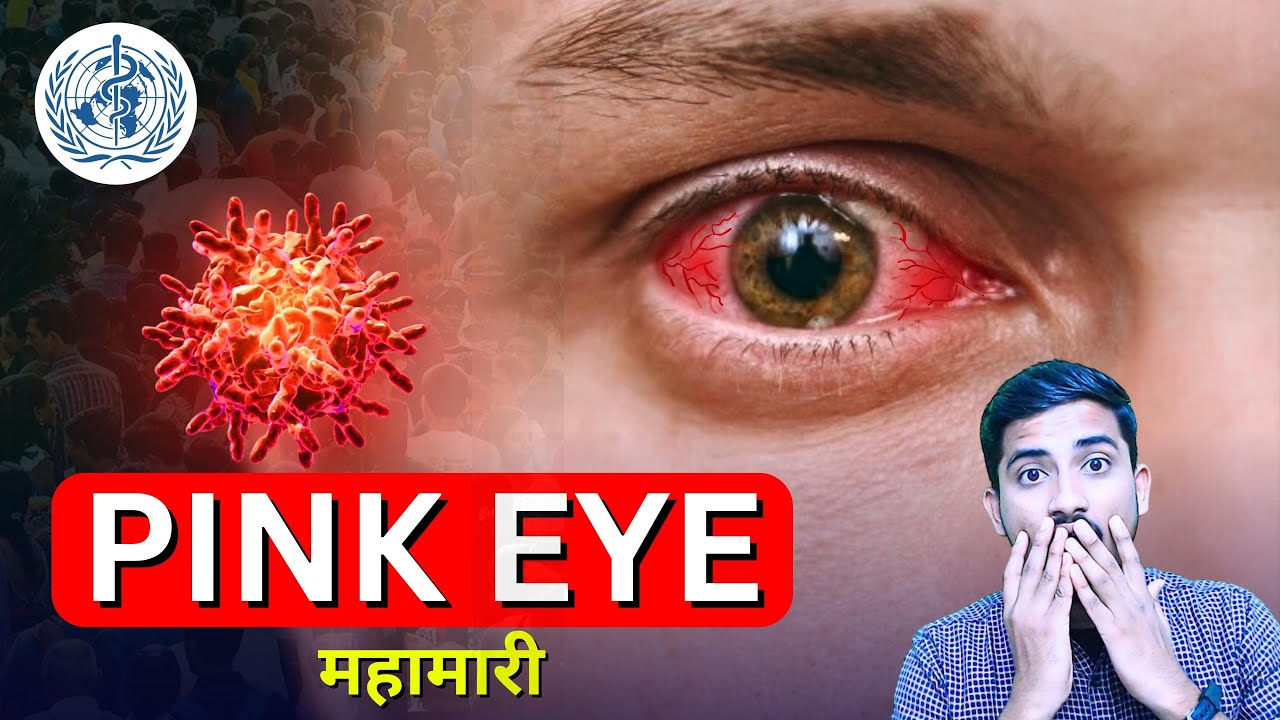Pink Eye Causes, Symptoms & Prevention During Monsoon
