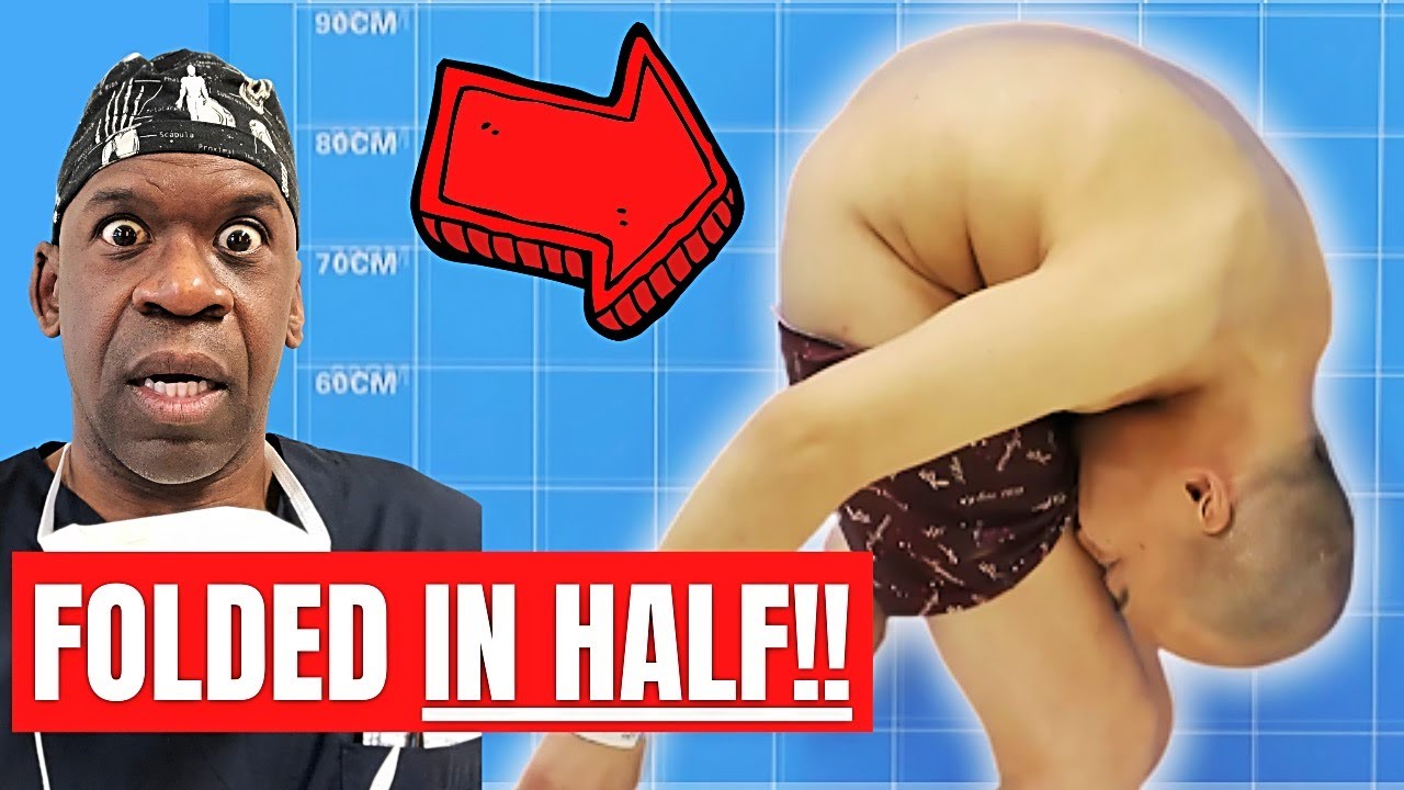 Correcting Extreme Spinal Deformity: The Folded Man's Surgical Journey