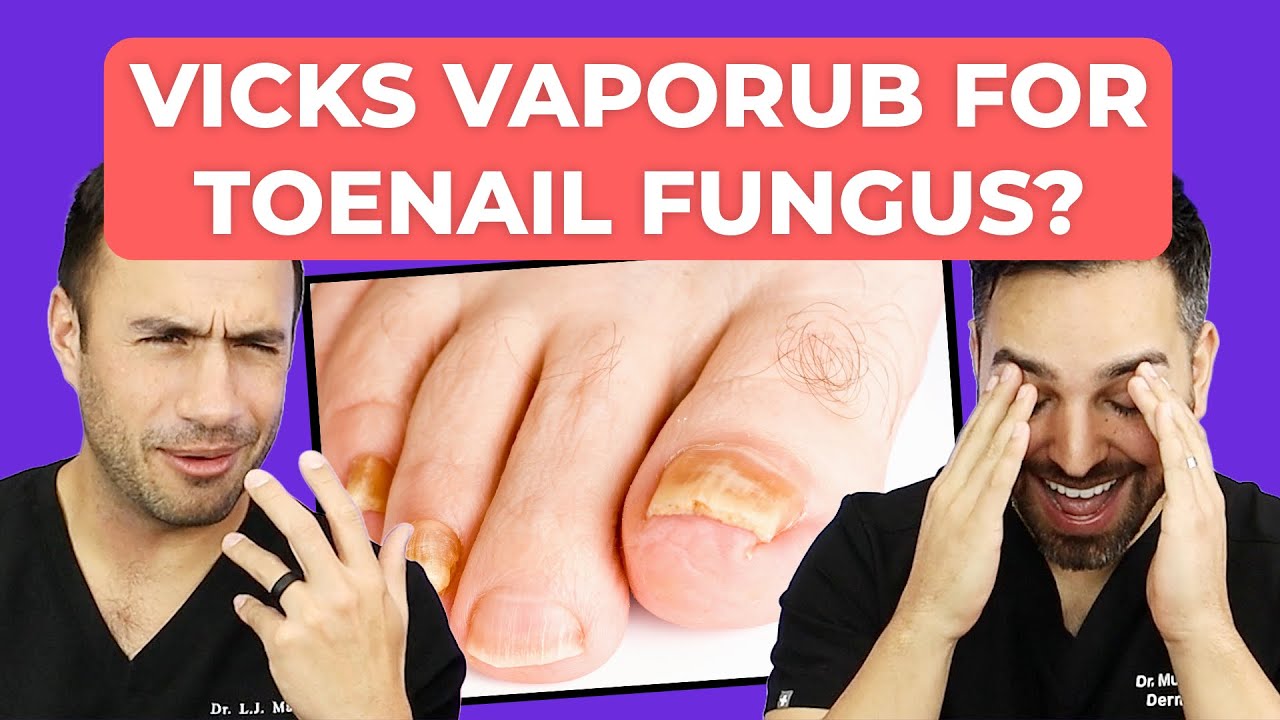 Vicks Vaporub for Toenail Fungus: Evidence-Based Guide