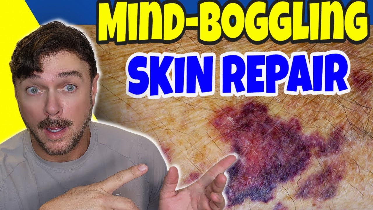 Natural Oils for Aging Skin: Bruising, Tears & Veins Solutions