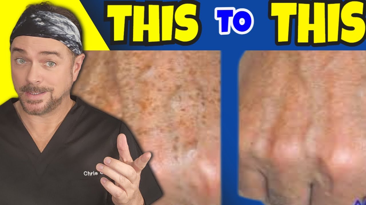 Top 3 Acids for Hyperpigmentation: Expert Anti-Aging Guide