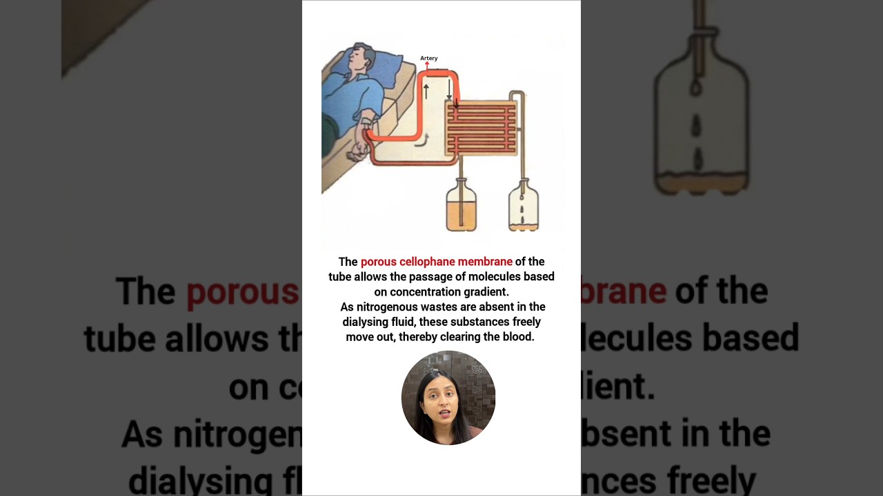 How Hemodialysis Works: Artificial Kidney Treatment Explained