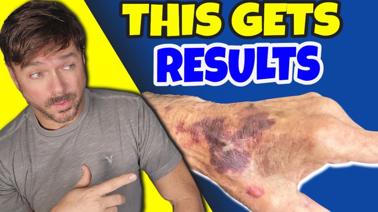 Helichrysum Oil for Bruise Healing & Skin Repair