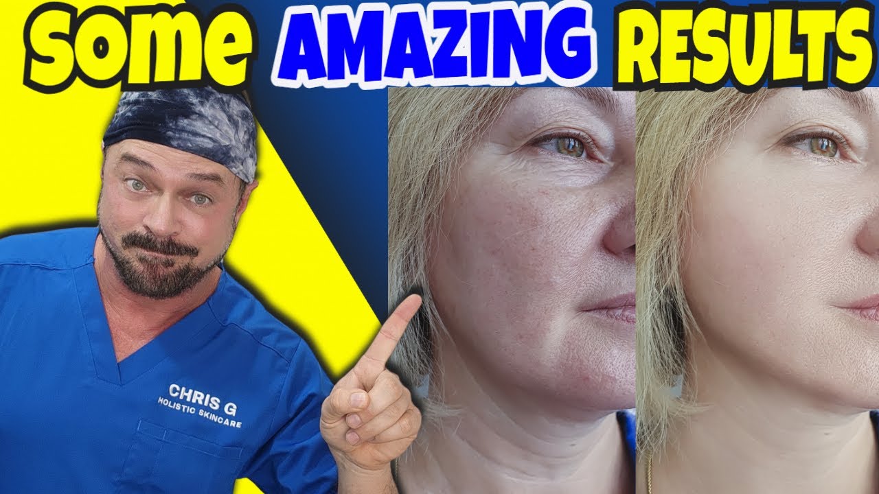 Gentle Retinol Alternatives: Achieve Youthful Skin Without Irritation