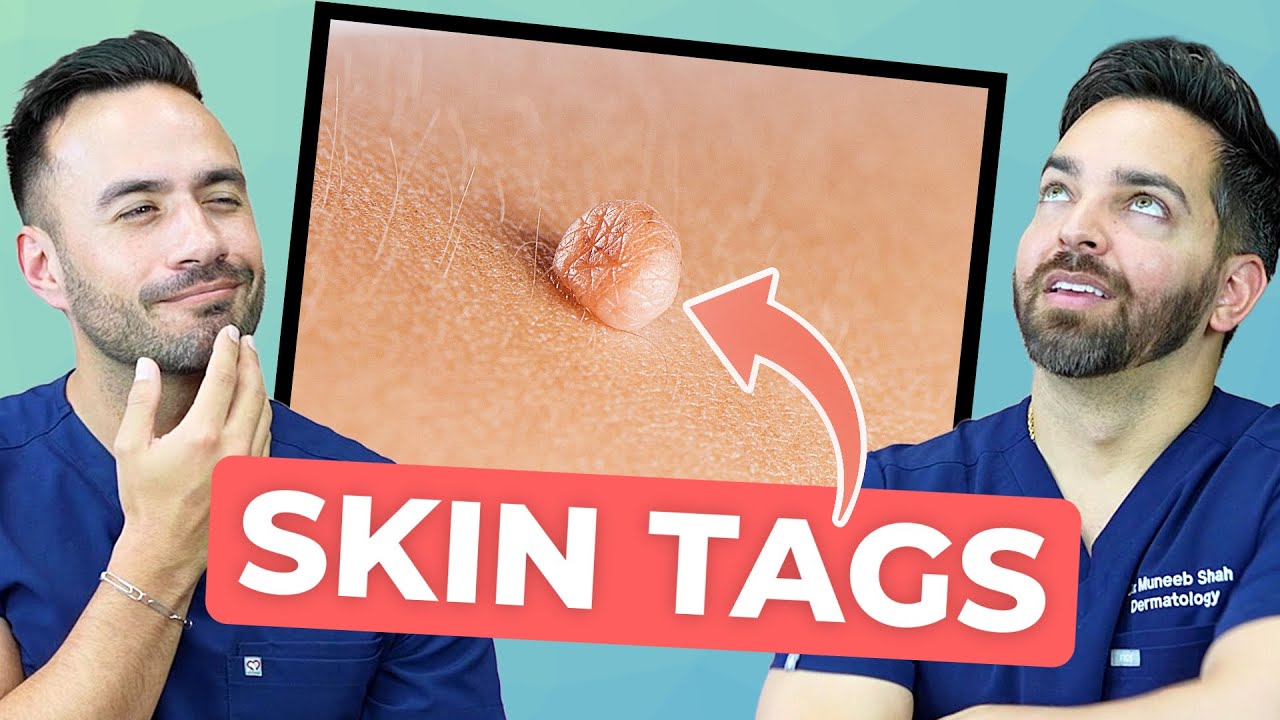 Skin Tag Removal: Safe Methods vs. Risky Home Remedies