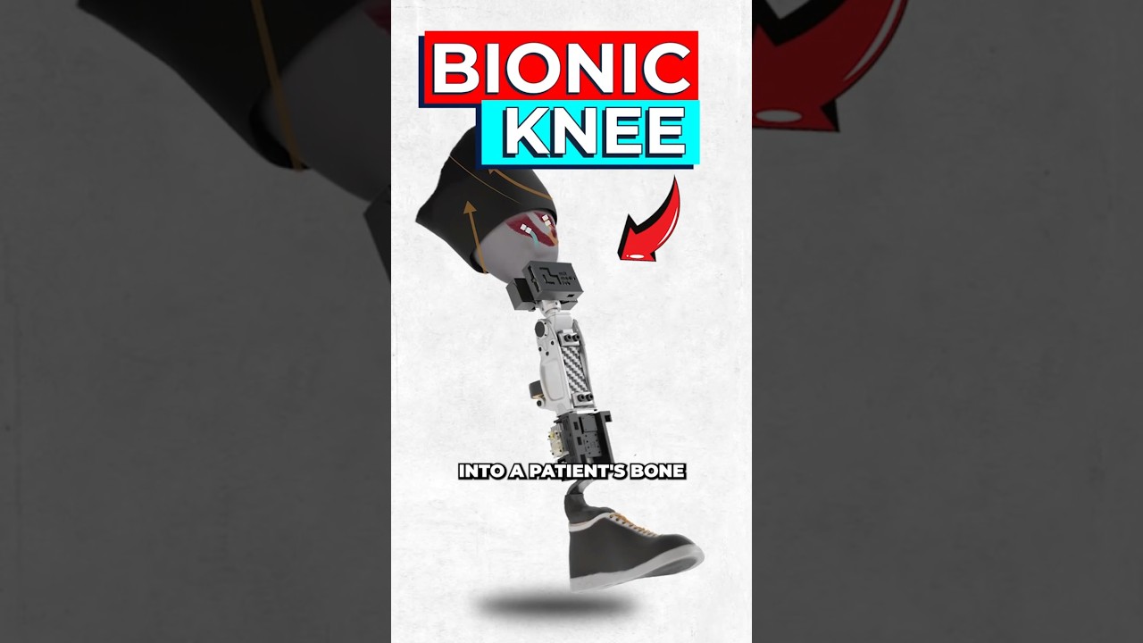 OMP Bionic Knee: How MIT’s Implant Outperforms Traditional Prosthetics