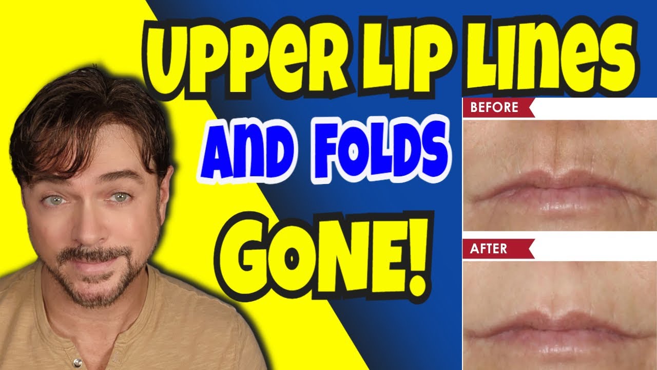 Reduce Smoker's Lines & Nasolabial Folds Without Fillers