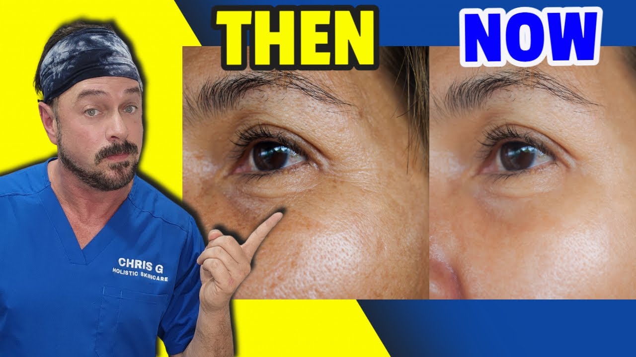 Fast Results: Top Acids for Age Spots & Skin Rejuvenation