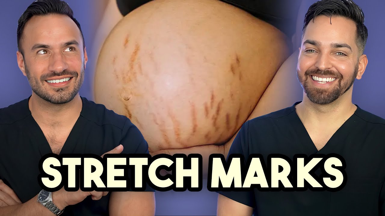 Stretch Marks: Causes, Prevention & Treatment Options