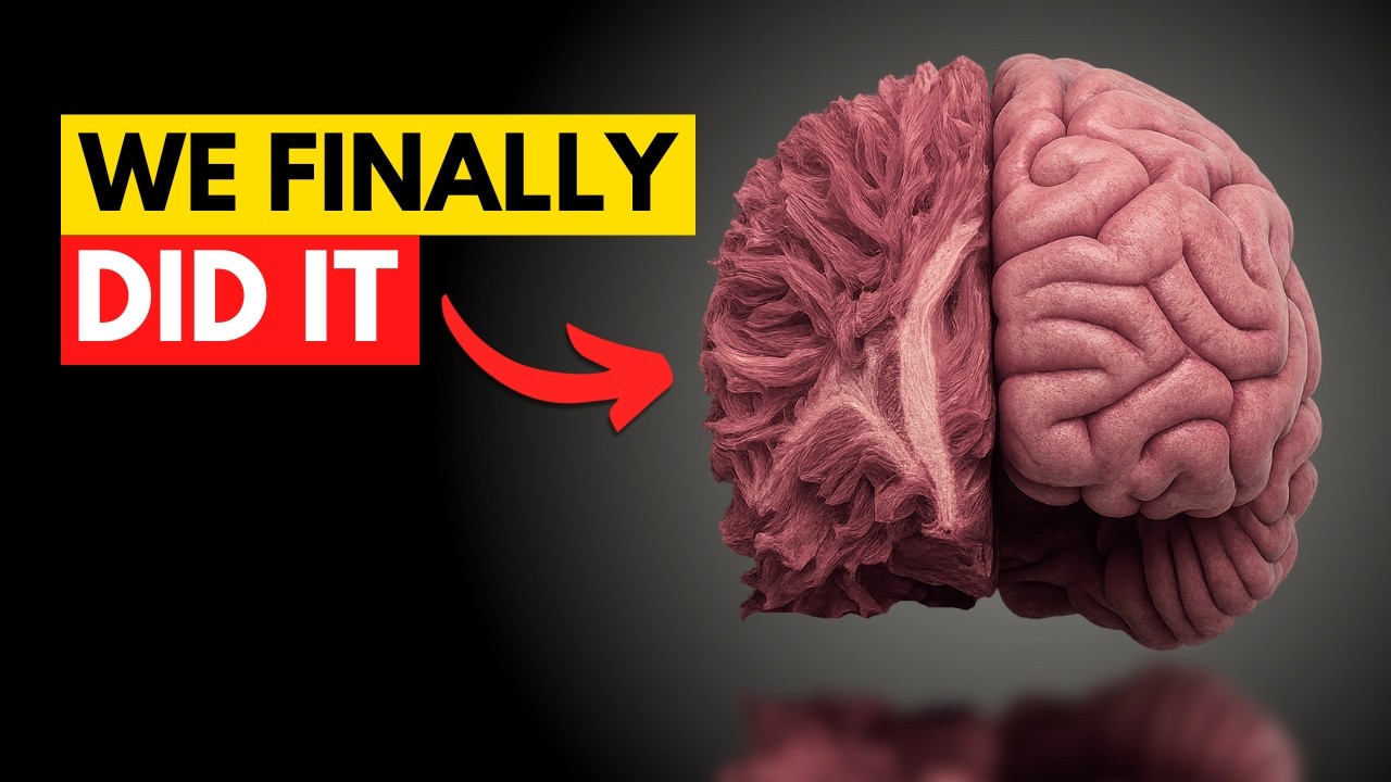 Huntington's Disease Breakthrough: Gene Therapy Slows Progression by 75%