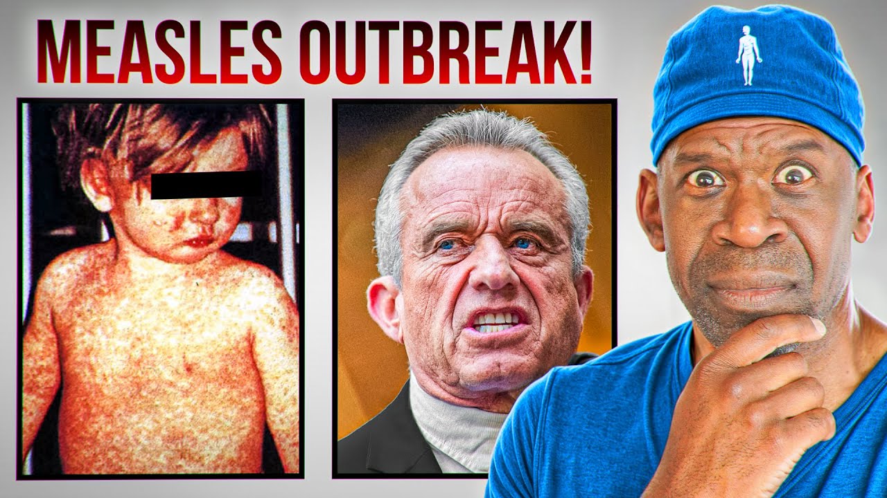 Measles Outbreak 2025: Why Vaccine Hesitancy Fuels Resurgence