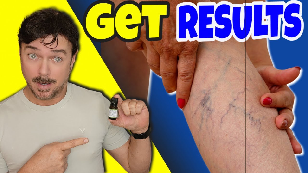 Natural Spider Vein & Varicose Vein Treatments: 3 Proven Oils + Cream