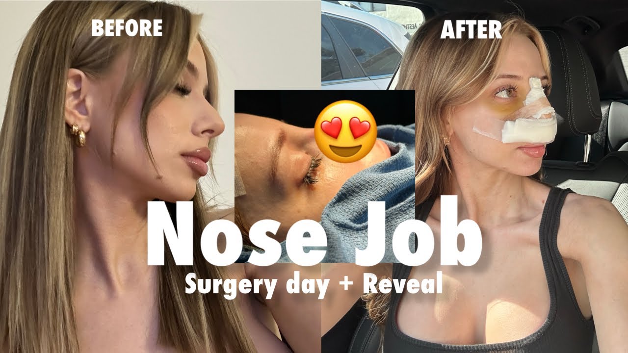 Rhinoplasty Recovery Guide: Day-by-Day Tips & Essential Steps