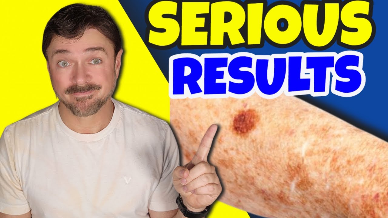 Effective Hyperpigmentation Treatments for Dark Spots & Melasma