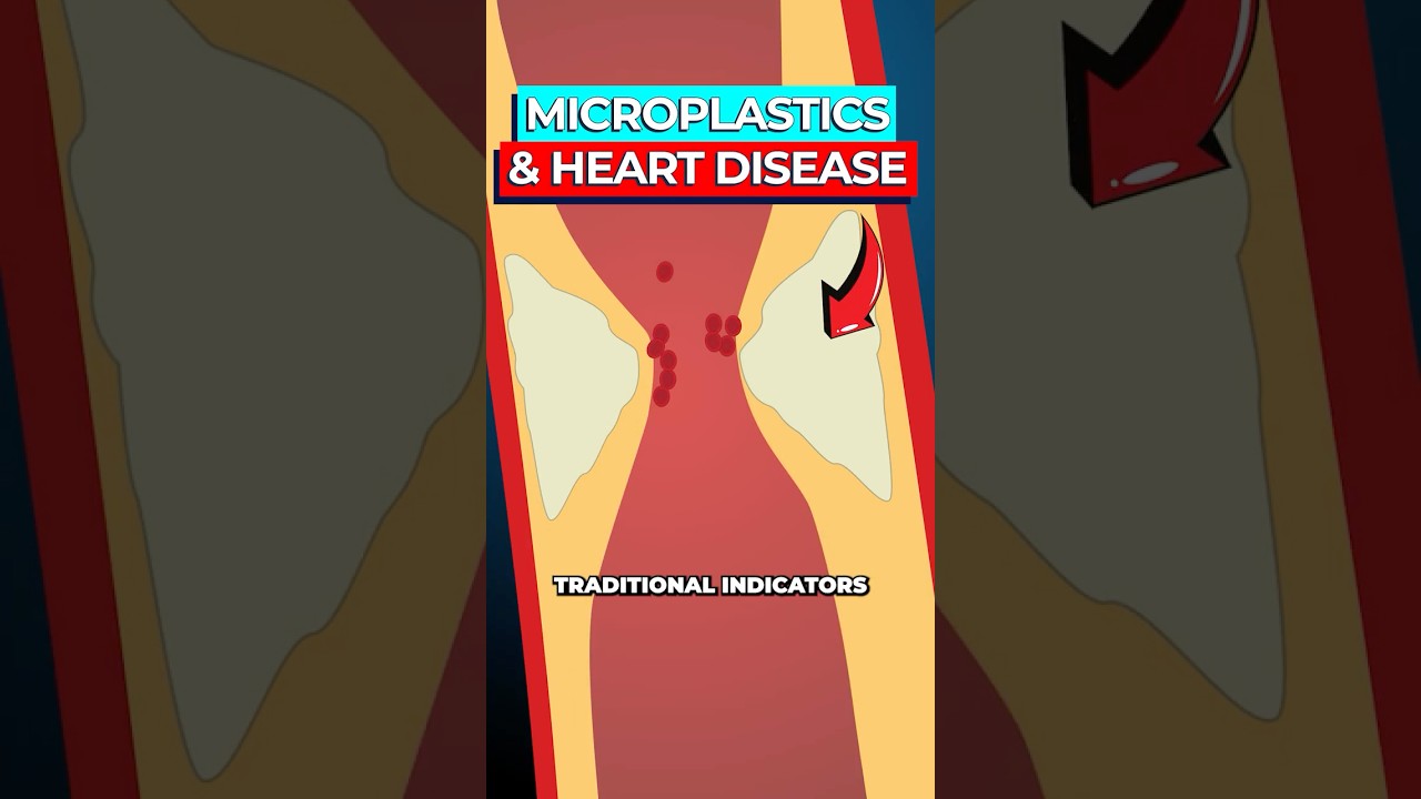 Microplastics Cause Arterial Plaque, New Study Reveals