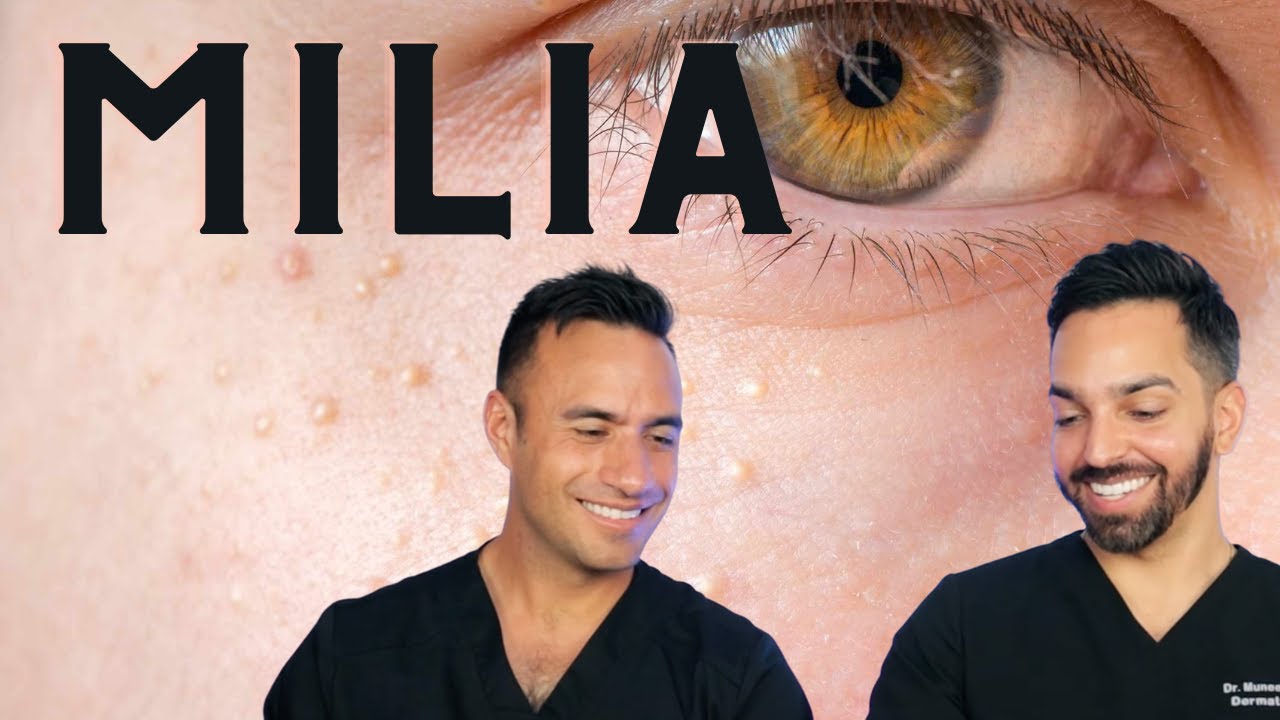 Milia Treatment: Dermatologist Prevention & Removal Tips