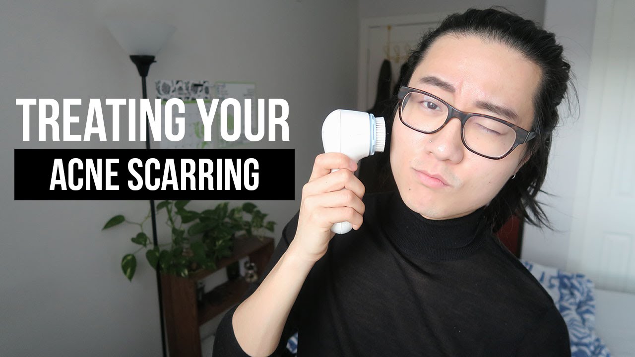 How to Fade Acne Scars Naturally: Proven Methods & Products