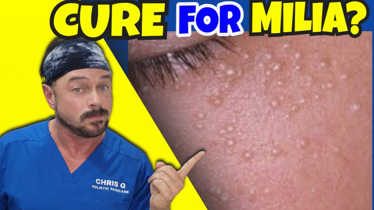 How to Remove Milia: 3 Non-Invasive Solutions That Work