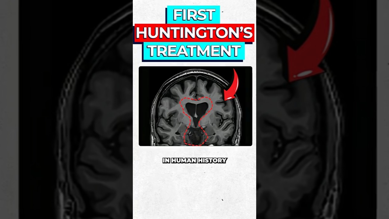 Huntington's Breakthrough: How RNA Therapy Halts Neuron Damage