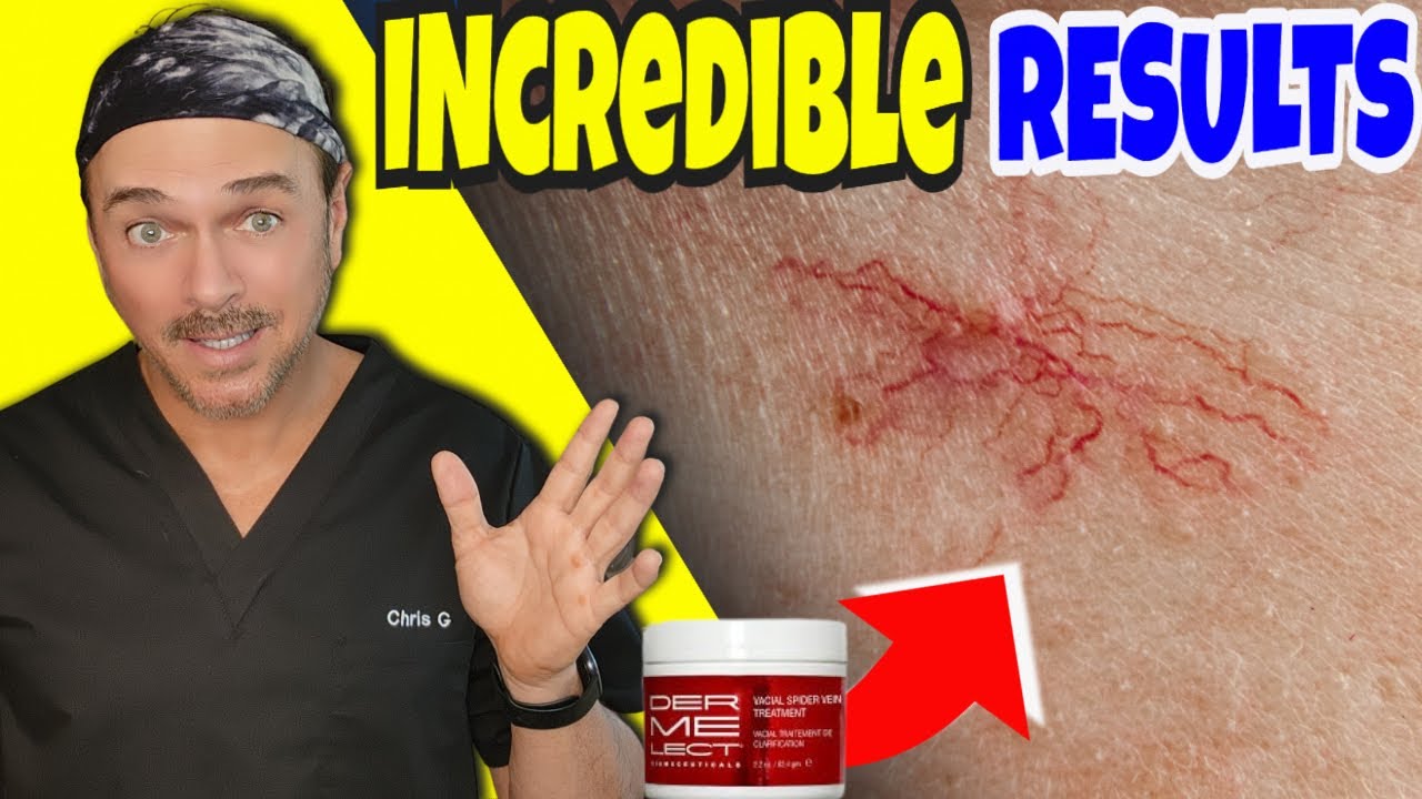 Dermalex Spider Vein Treatment Review | Expert Skincare Guide