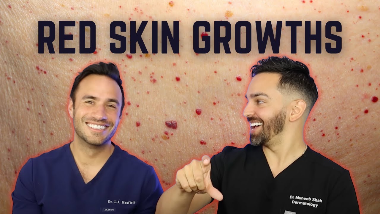 Cherry Angiomas: Debunking Myths and Revealing Facts