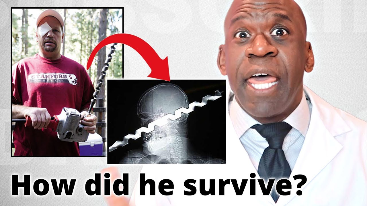 Ron Hunt's Survival: How a Skull Drill Impalement Defied Odds