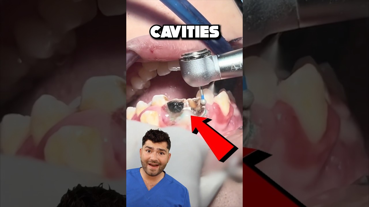Cavity Removal and Restoration Process Explained Step by Step