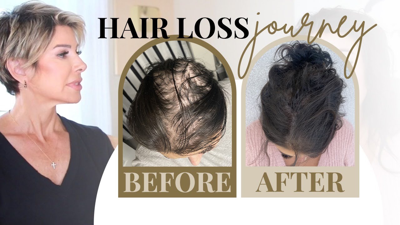 Female Hair Loss Solutions: Causes, Treatments & Styling Hacks