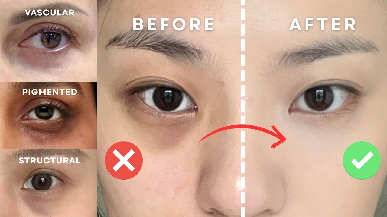 How to Conceal Dark Circles Based on Your Specific Type