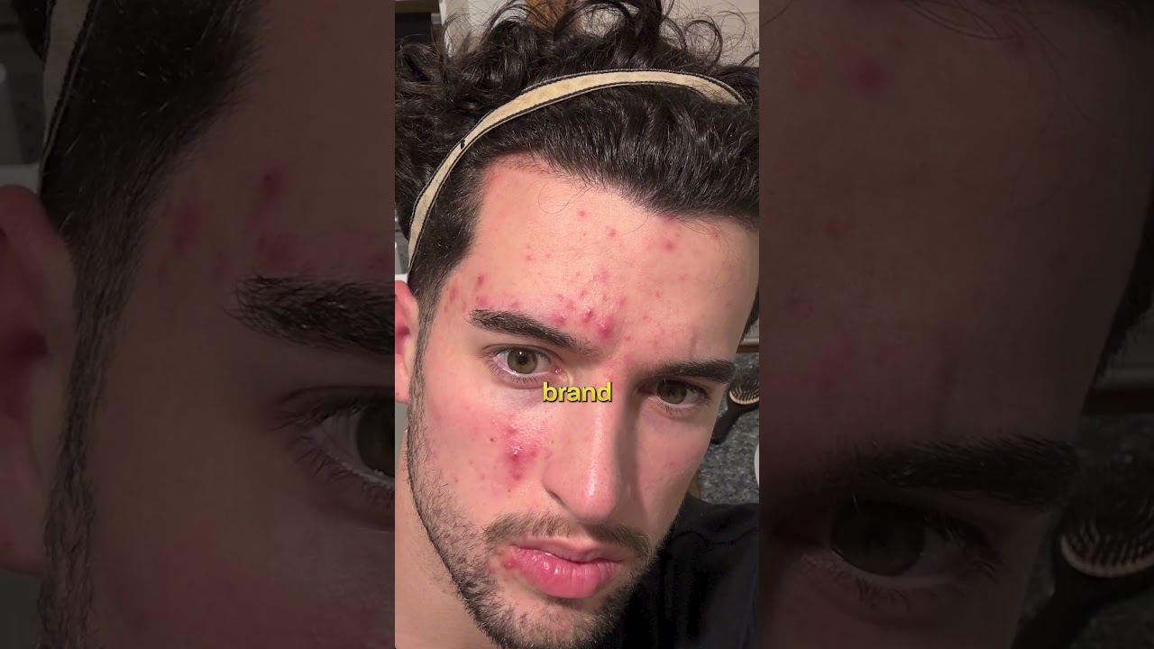 Gentle Skincare and Diet Fix Acne: Real Results Strategy