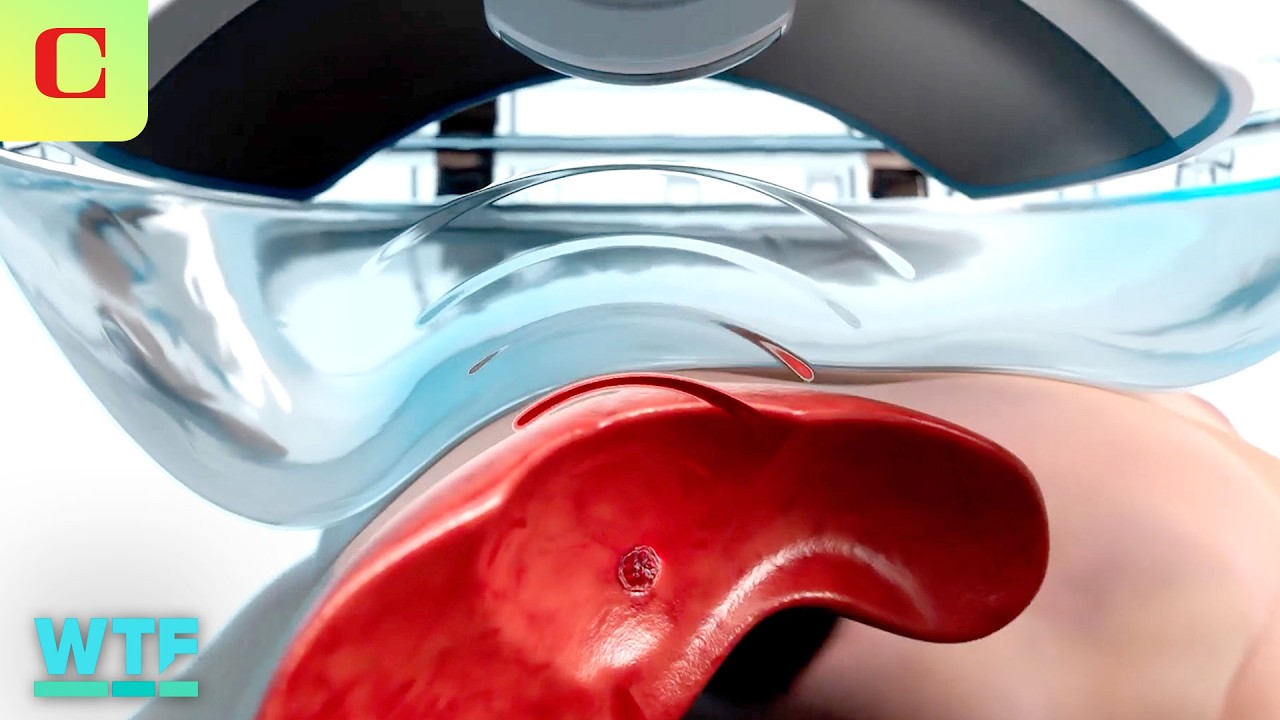 Histotripsy: Non-Invasive Tumor Treatment Explained