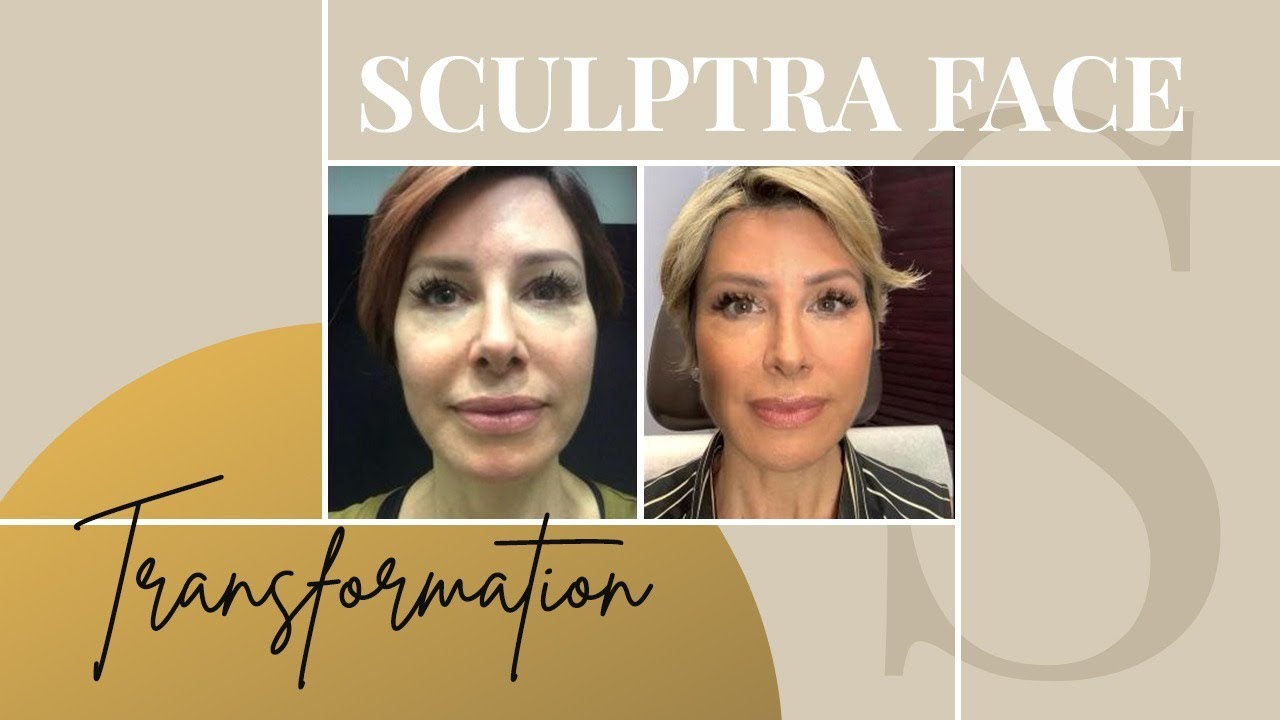 Sculptra Collagen Treatment: Natural Lift & Wrinkle Reduction Guide